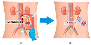 Scientists develop artificial kidney that may end dialysis Scientists develop artificial kidney that may end dialysis